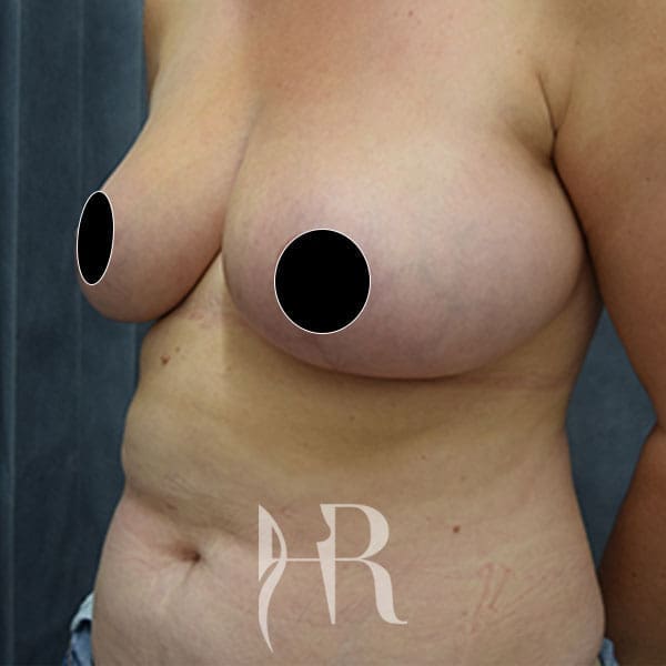 HR Plastic Surgery - Breast Reduction patient after 9